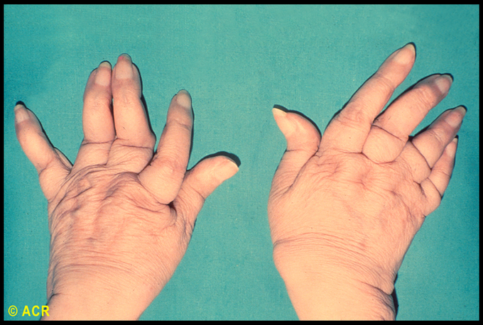 What's the name of this sign in Rheumatoid arthritis??