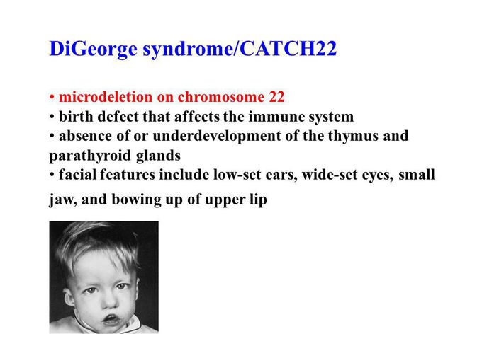 Digeorge syndrome