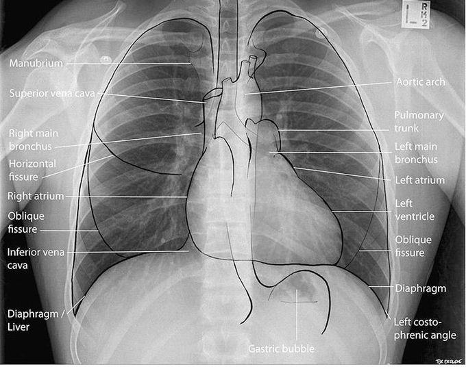 Chest xray basic anatomy MEDizzy