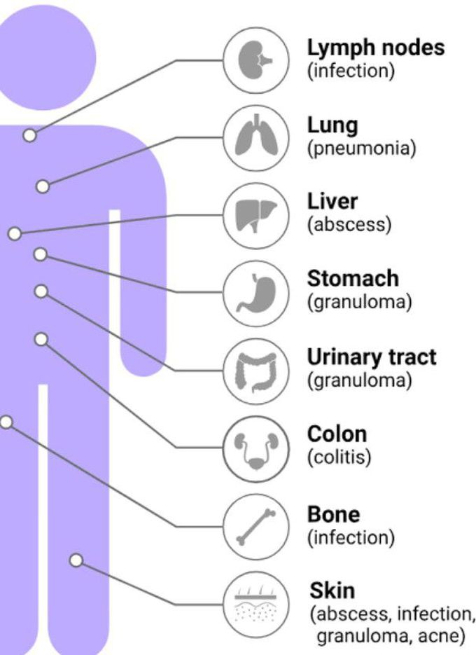 Symptoms of Granuloma