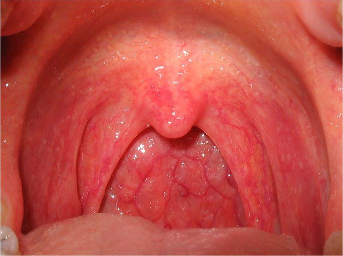 Acute pharyngitis