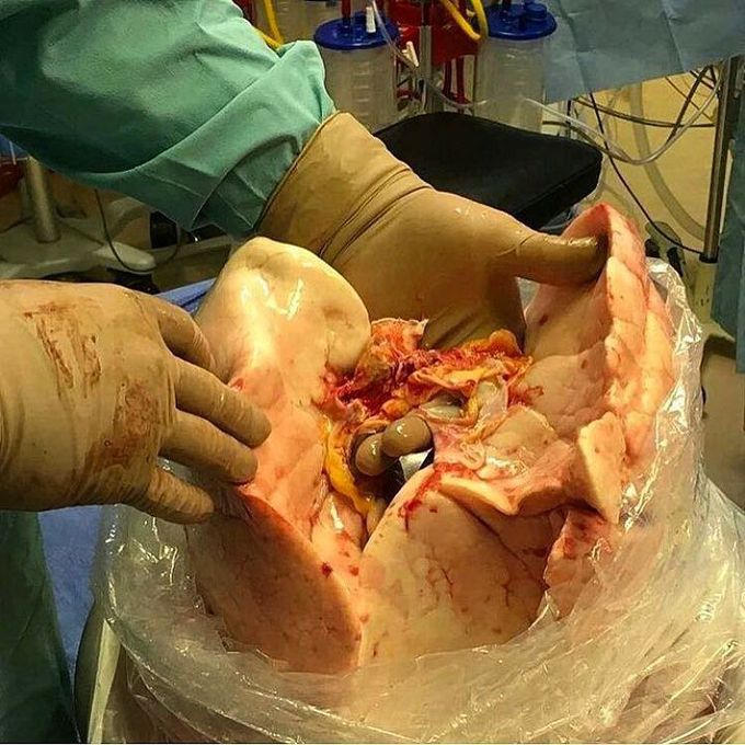 Fresh new pair of lungs about to get transplanted!