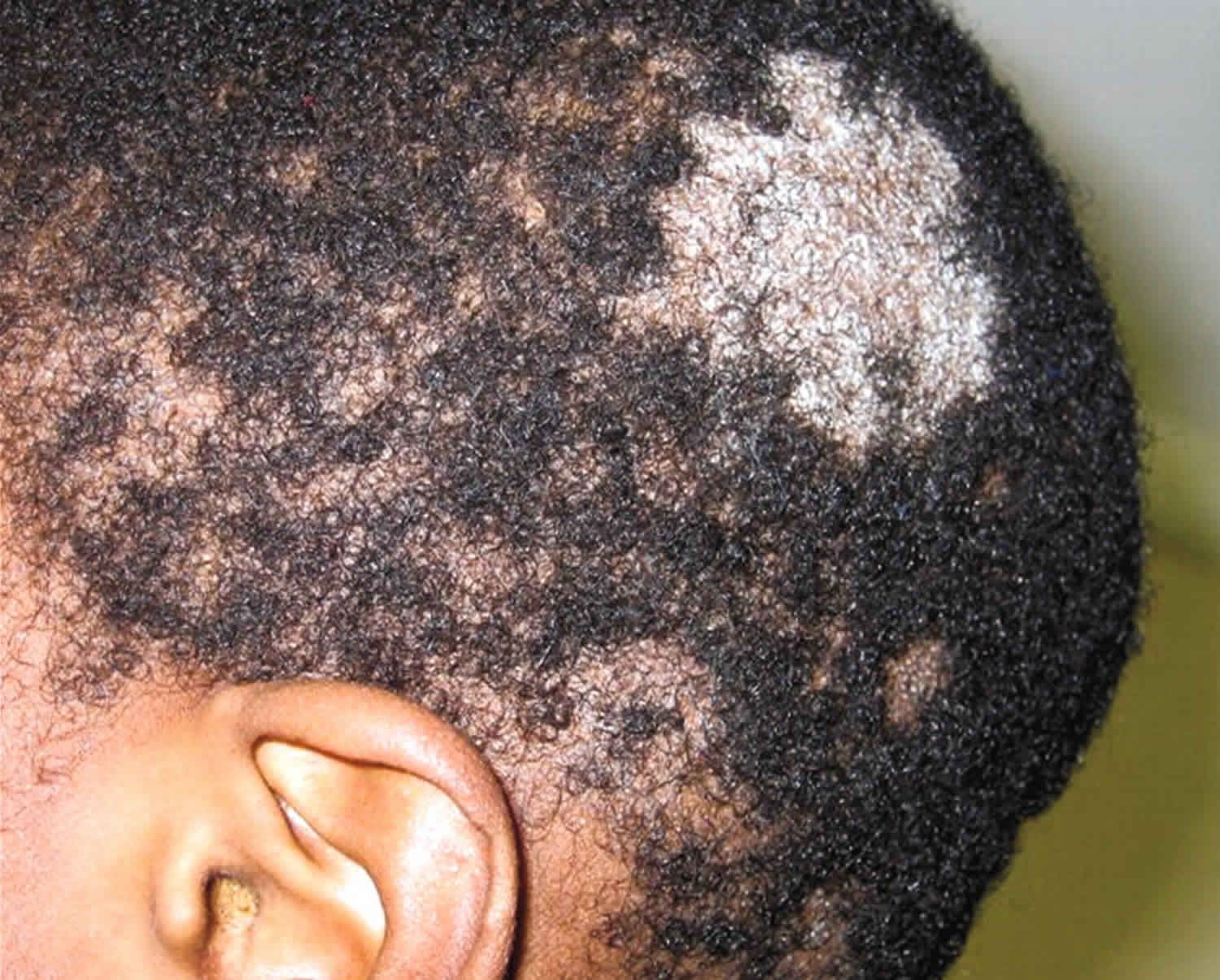 Tinea Capitis Due to Microsporum canis