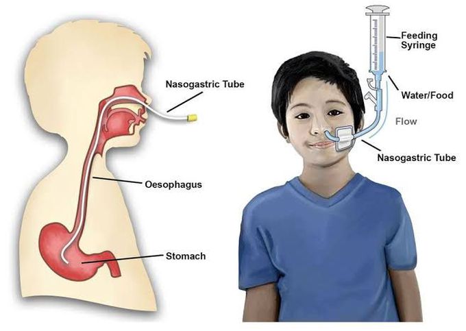 NG Tube