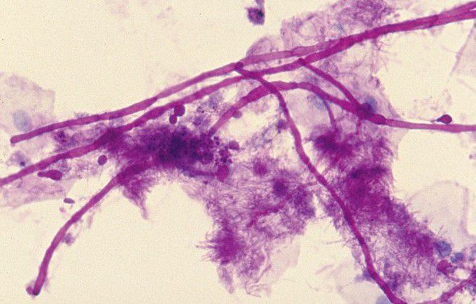 Candidiasis histopathology