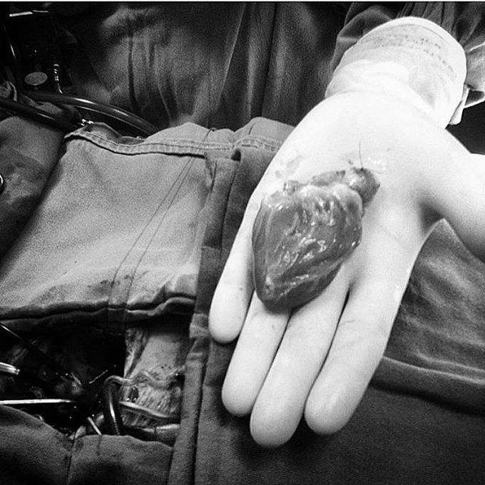 A rare look into a pediatric heart transplant procedure - the beginning of a new life 
