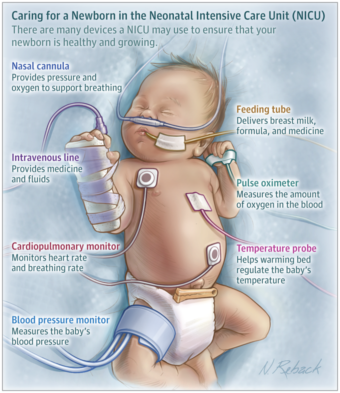 (NICU)