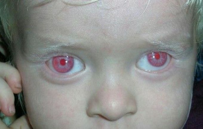 albinism eye problems