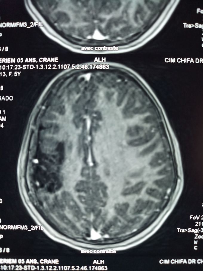 Hemiparesis  epilepsy facial asymetry 