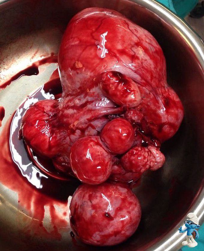 Multifibroid Uterus