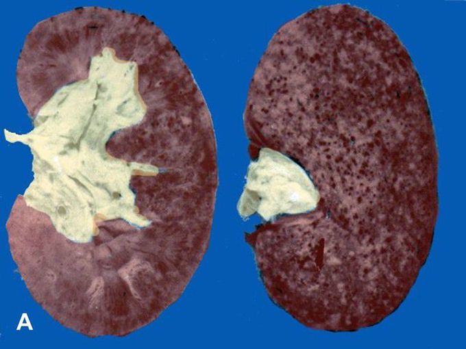 Flea Bitten Appearance of Kidneys