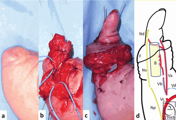 Temporary Ectopic Implantation of a Single Finger Using a Perforator as a Feeding Vessel, and Subsequent Prefabricated Chimeric Flap Transplantation