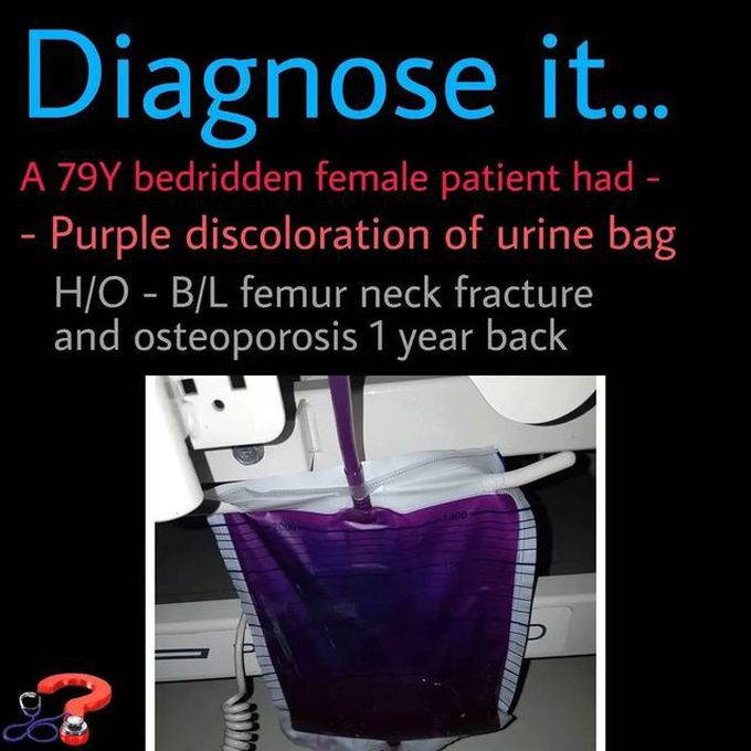 Purple Urine