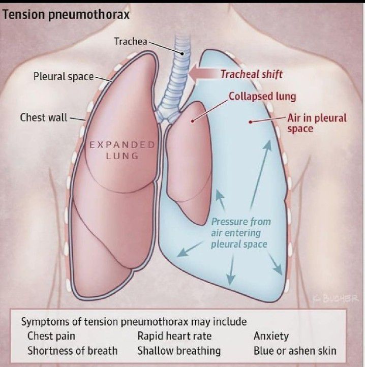 Tension pneumothorax - MEDizzy