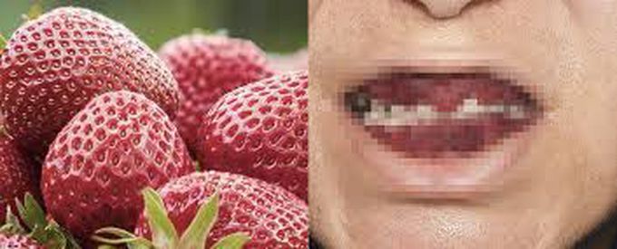 Symptoms of strawberry gingivitis