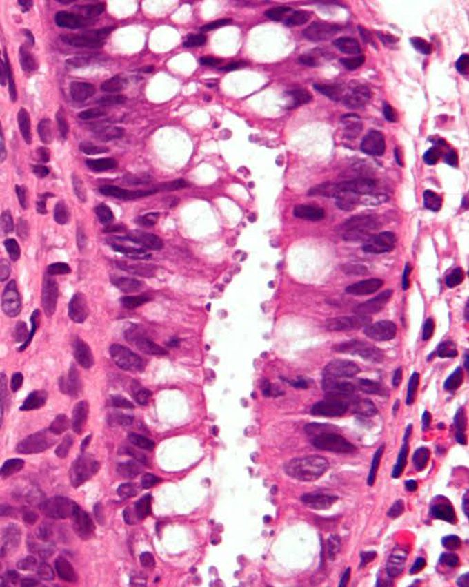 Cryptosporidiosis