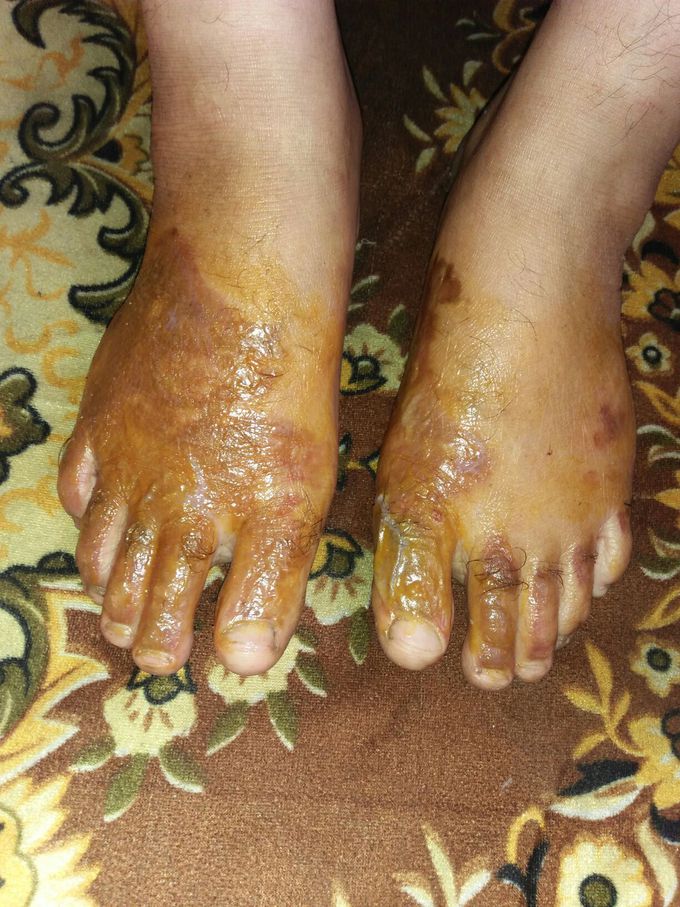 Burning feet