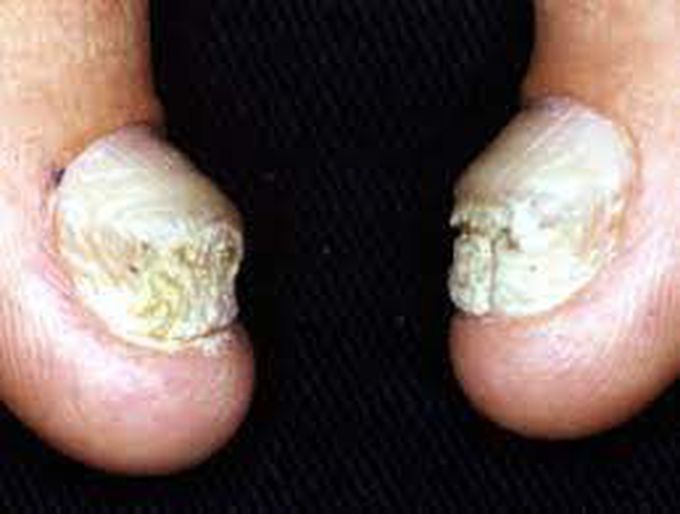 Causes of Pachyonychia Congenita
