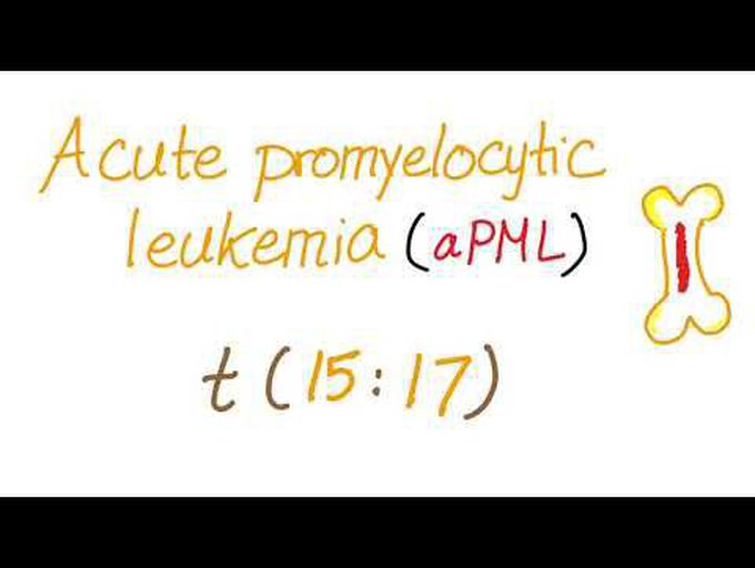 Acute Promyelocytic Leukema (aPML)