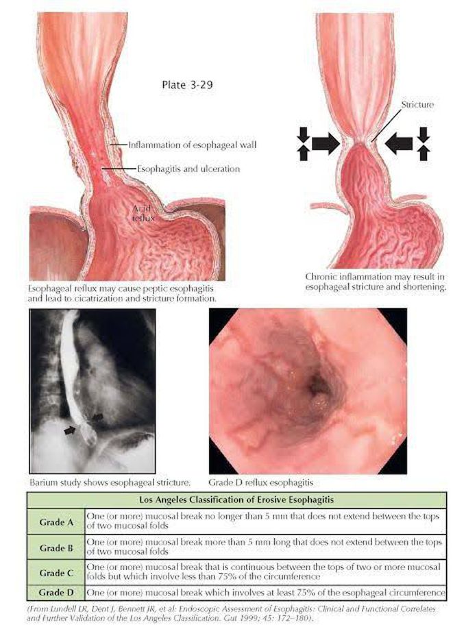 Classification of Erosive esophagitis