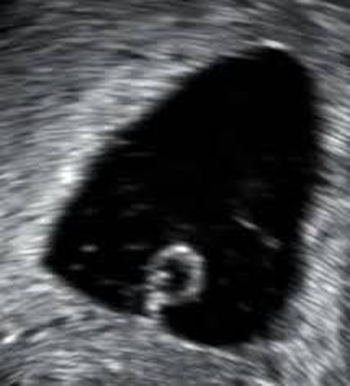 Anembryonic gestation