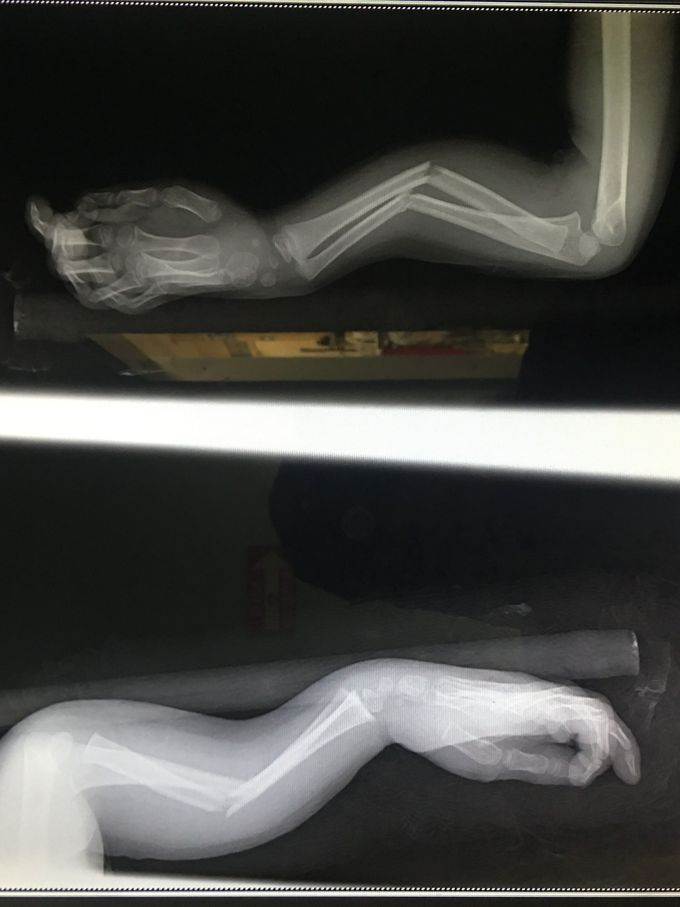 Fractura por caída de su misma altura