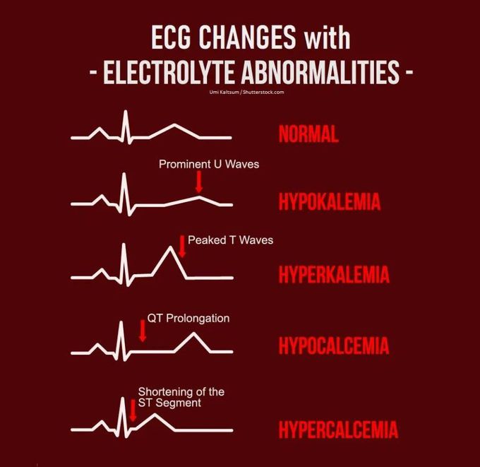 ECG Changes with Electrolytes