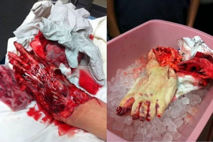 ⚠️ A complete degloving of the foot after a forklift accident! The patient was apparently ran over, causing the skin to peel right off. 