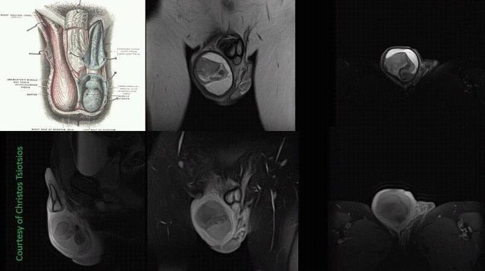 High-resolution scrotum MR Imaging