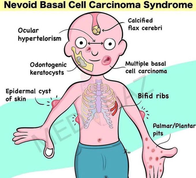 Nevoid basal cell carcinoma syndrome - MEDizzy