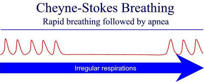 Cheyne stokes breathing