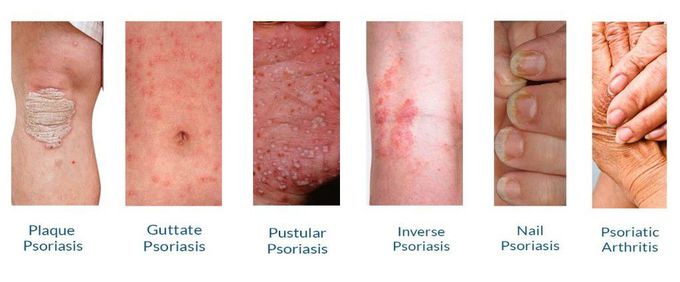 Types of Psoriasis