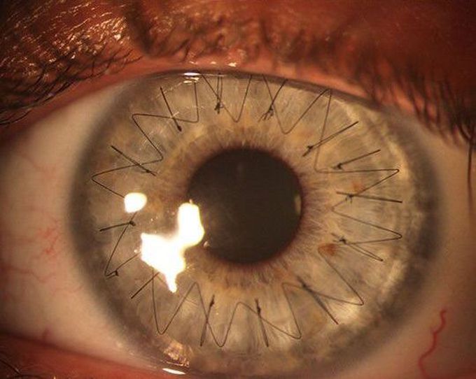 Cornea Transplant