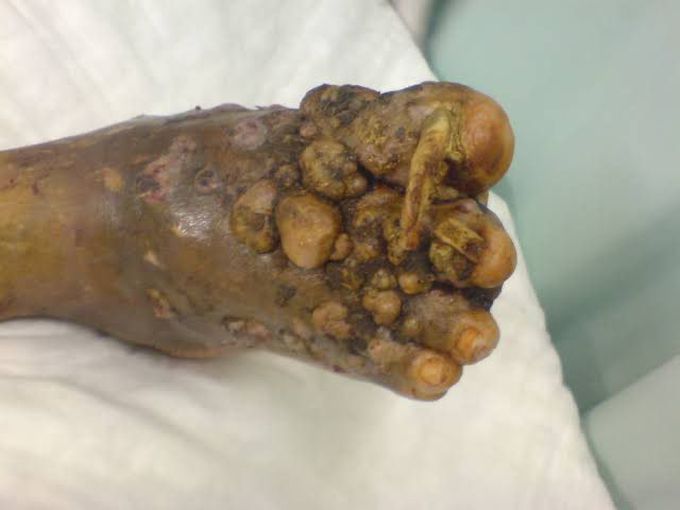 Madura foot