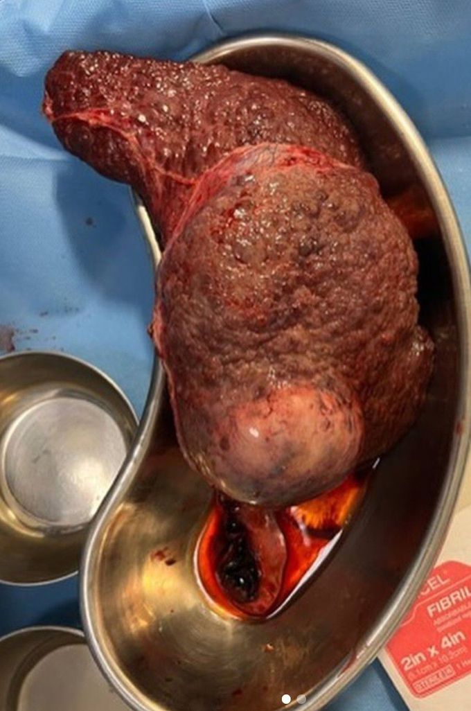 Liver Cirrhosis - Case Study