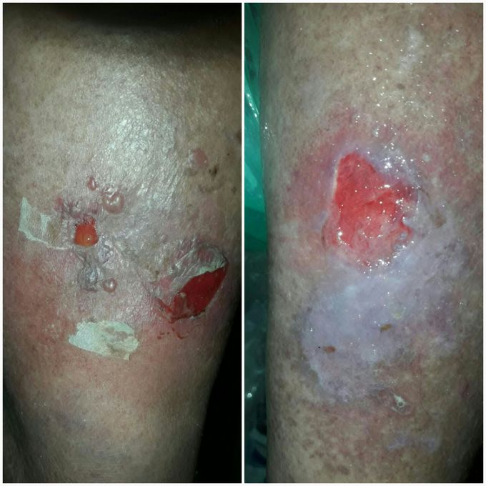 varicose wound