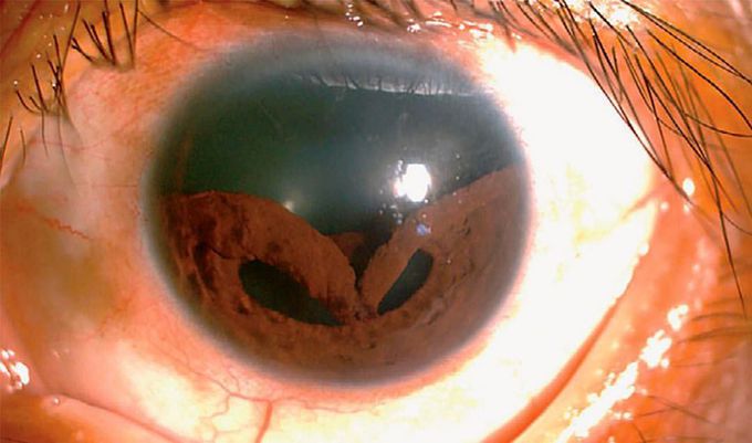 Bungee cord to the eye caused man's iris to collapse into multiple deformed pupils!!  