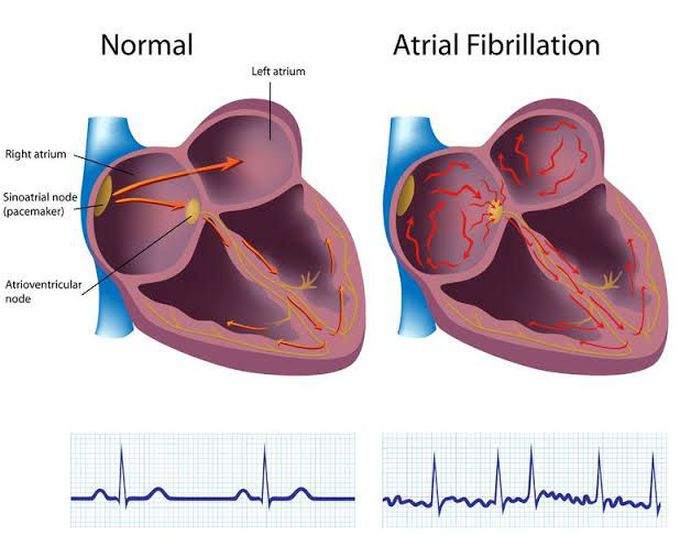 causes of atrial fibrillation