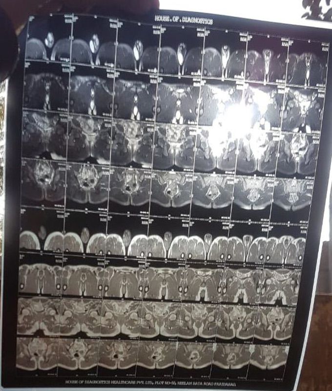 Abdominal pain