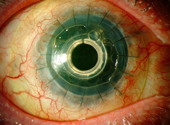 Artificial Cornea