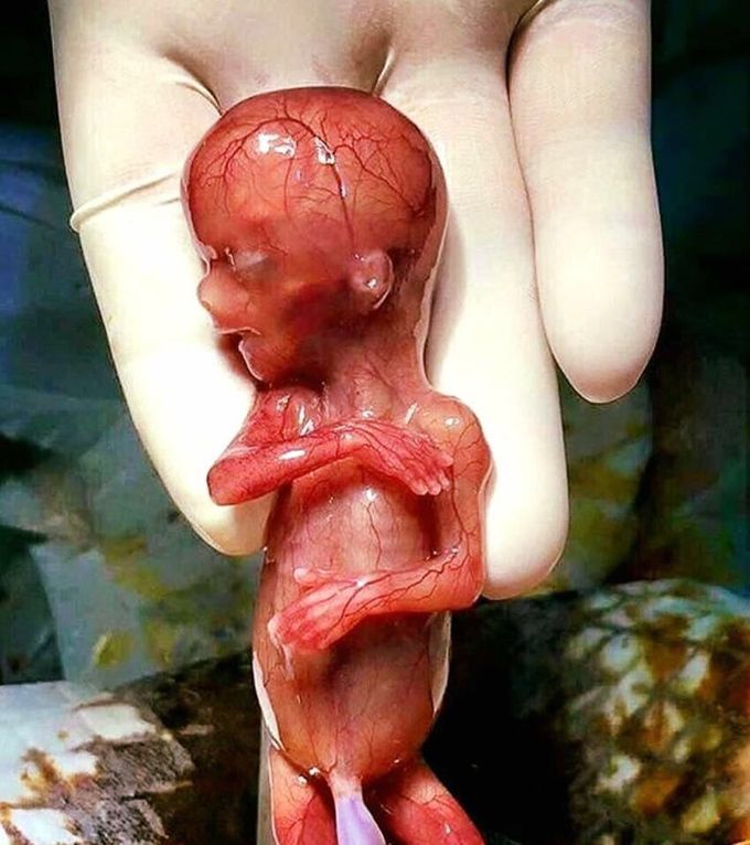 FETUS