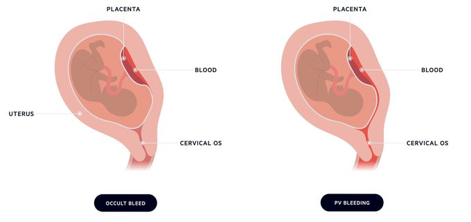Etiology of Antepartum Hemorrhage