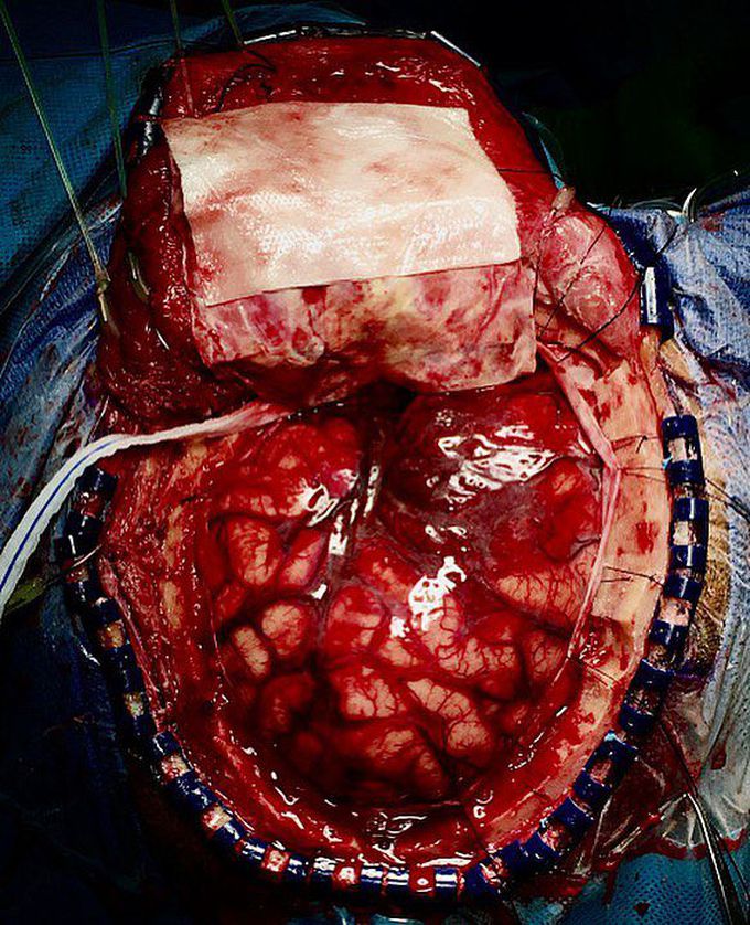 Surgery for aneurysmal subarachnoid hemorrhage!!