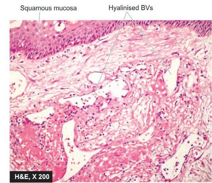 Laryngeal nodule.