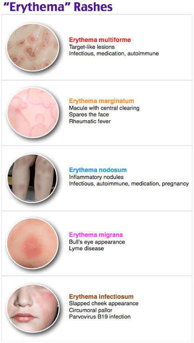 Erythema Rashes