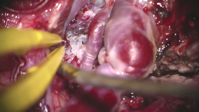 Resection of Left Frontal Arteriovenous Malformation after Radiosurgery