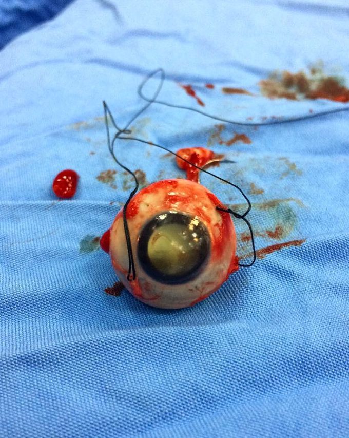 Enucleation (surgical removal of the eye) in a patient with retinoblastoma! 👀