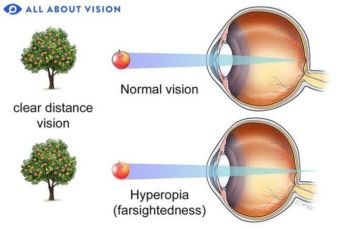 Treatment of hyperopia