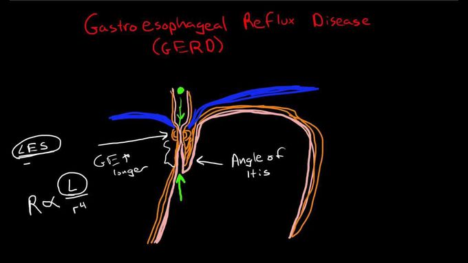 GERD Overview