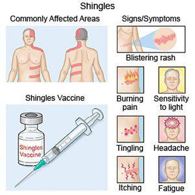 Signs and symptoms of Shingles